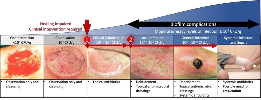 the wound infection continuum